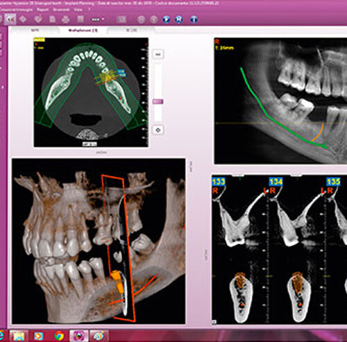 RPA Dental Equipment Digital Imaging MyRay iRYS